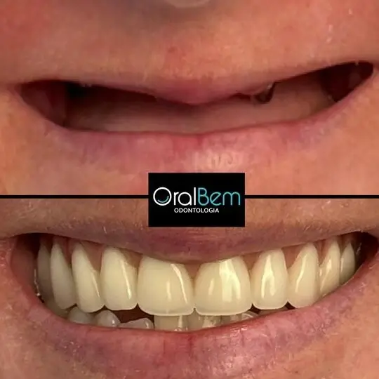 Olrabem antes e depois