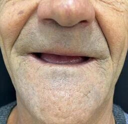 antes dentes oralbem