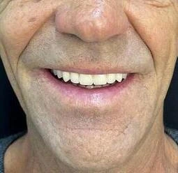 depois dentes oralbem